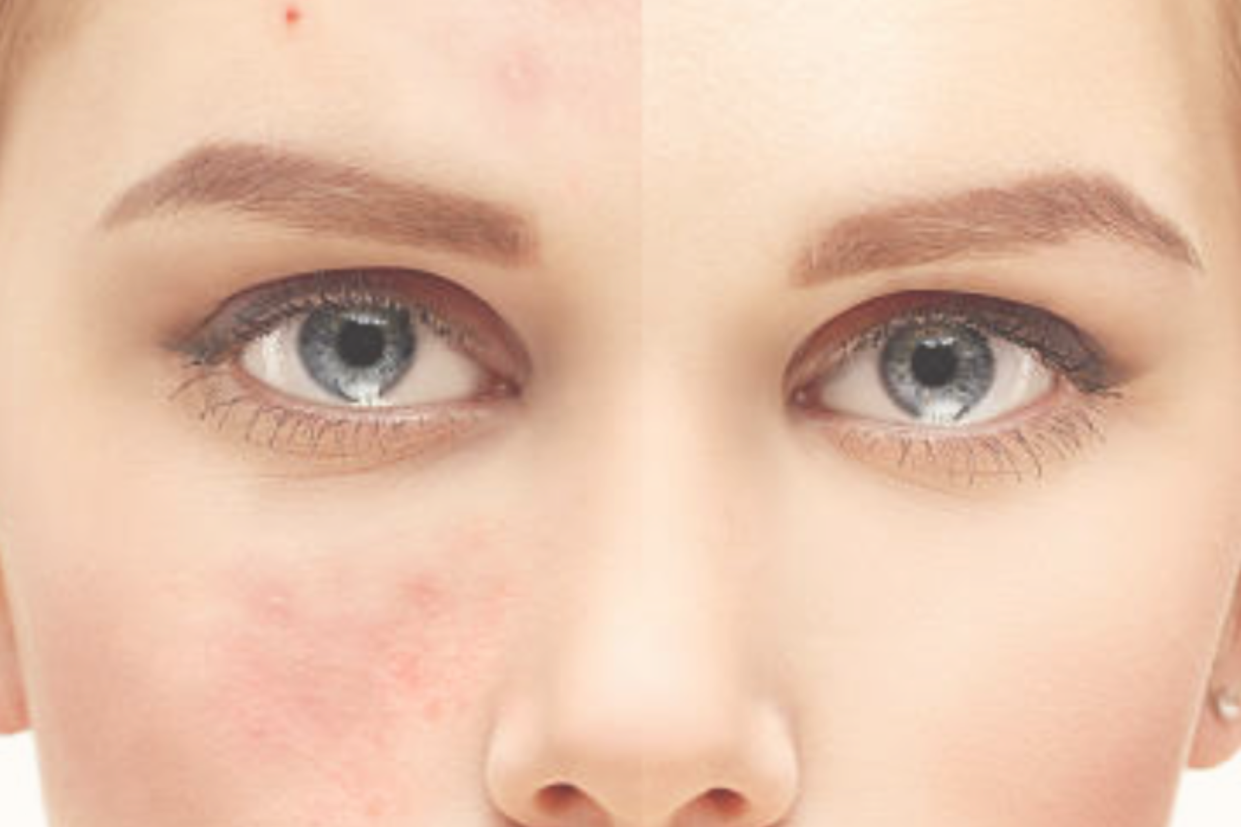 Laser Treatment | Elegant Clinic