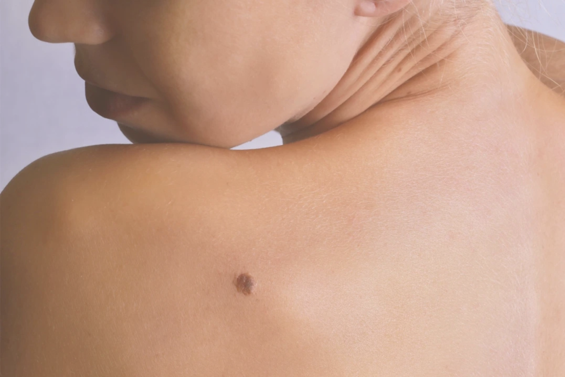 Skin Tag Removal | Elegant Clinic Skin Tag Removal | Elegant Clinic